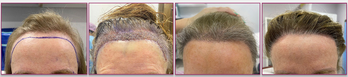 Dermamax Happy Customer - Hair Transplant