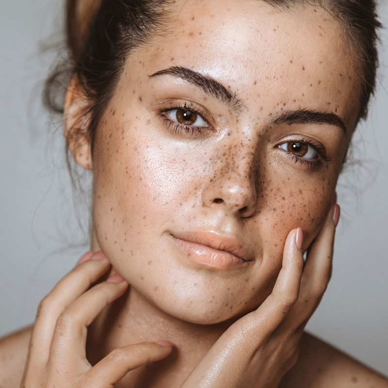 Freckles & Pigmentation Treatment